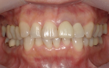 Before